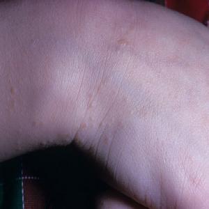 Choroba skóry dłoni u dziecka liszaj lśniący 