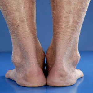 Choroba skóry rybia łuska pospolita