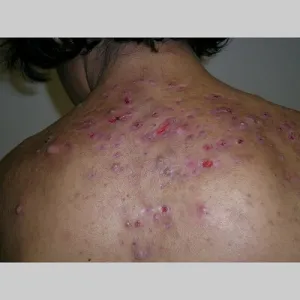 Choroba skóry trądzik piorunujący