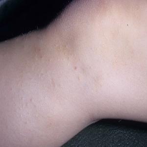 Choroba skóry u dziecka liszaj lśniący 