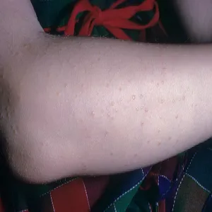 Choroba skóry u dziecka na ręce liszaj lśniący 