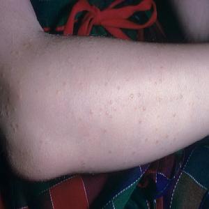 Choroba skóry u dziecka na ręce liszaj lśniący 