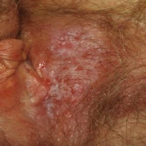 Choroba skóry ze świądem pozasutkowa choroba Pageta 