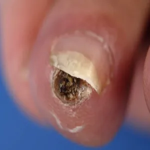 Choroba tropikalna tungiaza