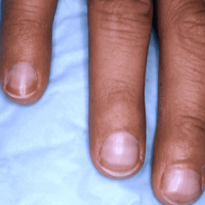 Choroba wątroby białe paznokcie