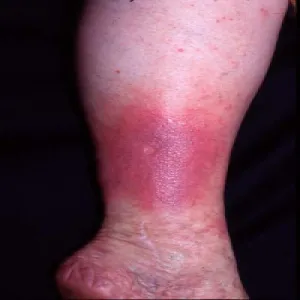 Choroba wyprysk podudzi 