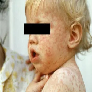 Choroba zakaźna odra u dzieci