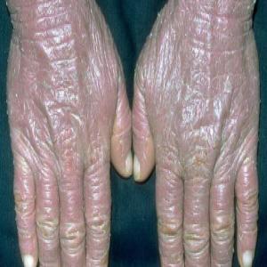 Choroba zespół Sezary’ego na skórze dłoni