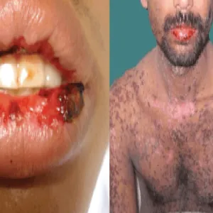 Choroba zespół Stevensa-Johnsona