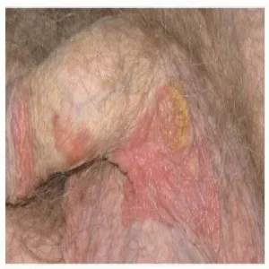 Choroby Bowena u mężczyzn okolice intymne