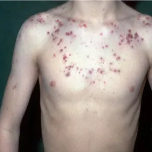 Choroby dermatologiczne trądzik piorunujący