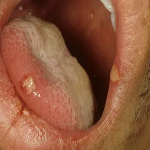 Choroby języka opryszczka