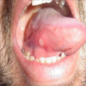 Choroby języka ropień na języku zdjęcia