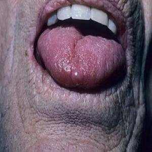 Choroby języka zdjęcia włókniak