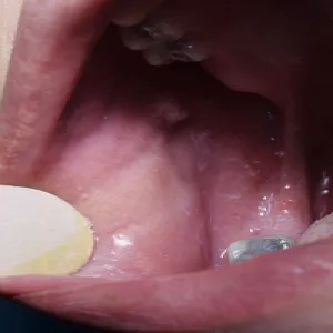 Choroby jamy ustnej i języka liszaj płaski