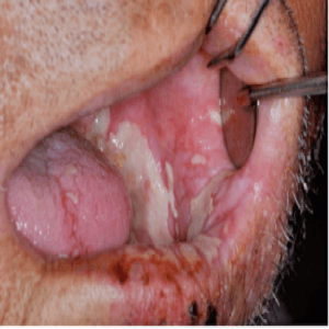 Choroby jamy ustnej zdjęcia półpasiec