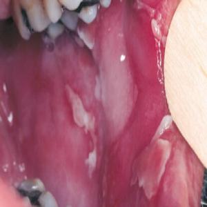 Choroby jamy ustnej zdjęcia pęcherzyca zwykła