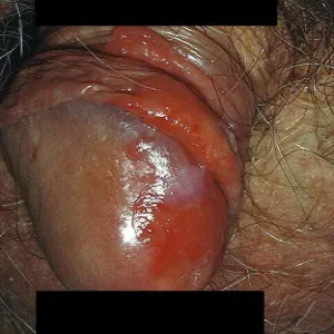 Choroby męskie erytroplazja Queyrata