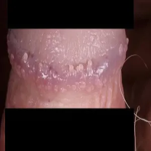 Choroby męskie grudki perliste