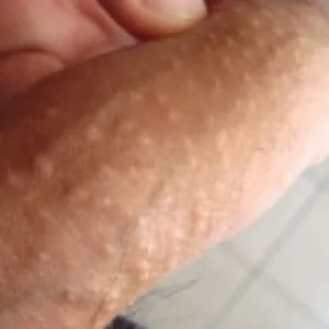 Choroby męskie zdjęcia plamki fordyce'a