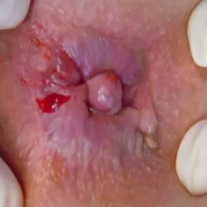 Choroby odbytu świąd szczelina odbytu 