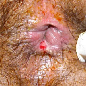 Choroby odbytu zdjęcia szczelina odbytu 