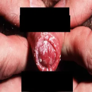 Choroby opis zdjęcia zapalenie napletka