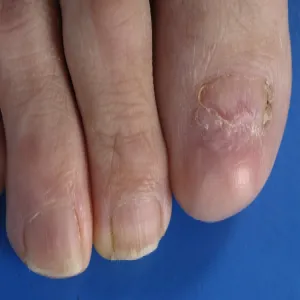 Choroby paznokci liszaj płaski