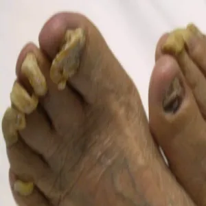 Choroby paznokci onychogryfoza