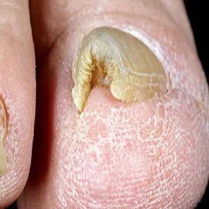 Choroby paznokci ptasi pazur