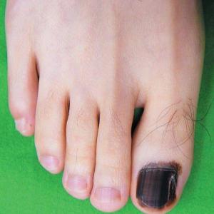 Choroby paznokci u nóg zdjęcia