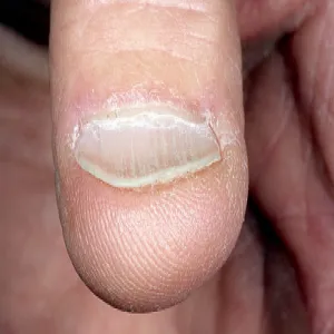 Choroby paznokci u rąk koilonychia