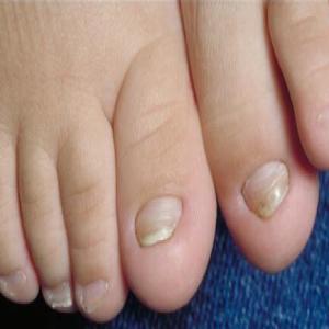 Choroby paznokci wrastające paznokcie onychokryptoza 