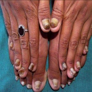 Choroby paznokci wrodzone zgrubienie paznokci 