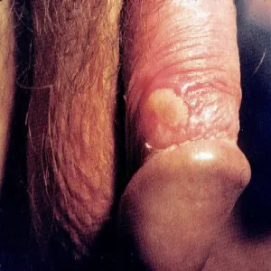 Choroby penisa choroba Behçeta 