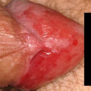 Choroby penisa erytroplazja Queyrata