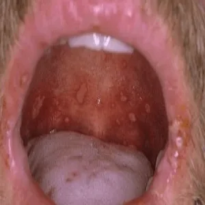 Choroby podniebienia pęcherzyca zwykła