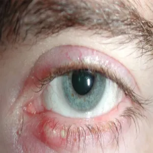 Choroby powiek u człowieka zapalenie brzegów powieki 