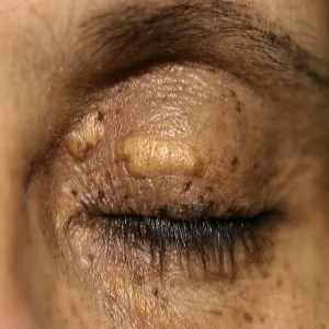 Choroby powiek zdjęcia objawy żółtaki 