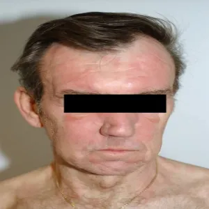 Choroby rzadkie zdjęcia Eozynofilowe zapalenie tkanki podskórnej