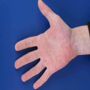 Choroby skórne na dłoniach wyprysk potnicowy