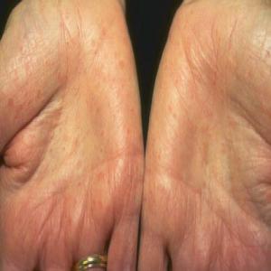 Choroby skórne dłoni choroba Dariera
