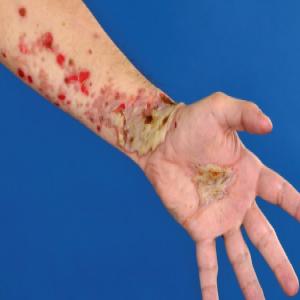 Choroby skórne dłoni pęcherzyca zwykła