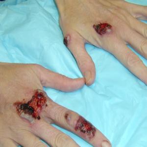 Choroby skórne dłoni piodermia zgorzelinowa