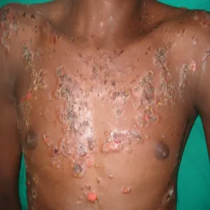 Choroby skórne na klatce piersiowej pęcherzyca zwykła