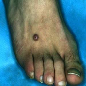 Choroby skórne stóp włókniaki