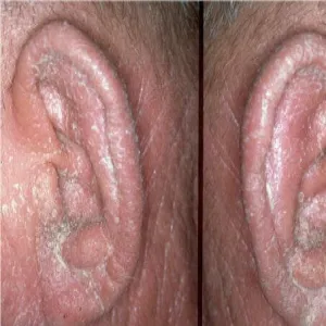 Choroby skórne uszu zespół Sezary’ego 