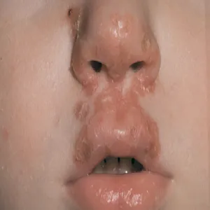 Choroby skóry liszajec u dziecka