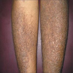 Choroby skóry nóg choroba amyloidozy skóry 