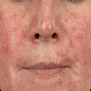 Choroby skóry na twarzy nużyca